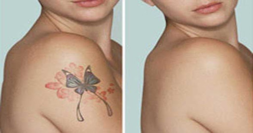 Laser Tattoo Removal  Paragould Plastic Surgery  Paragould AR