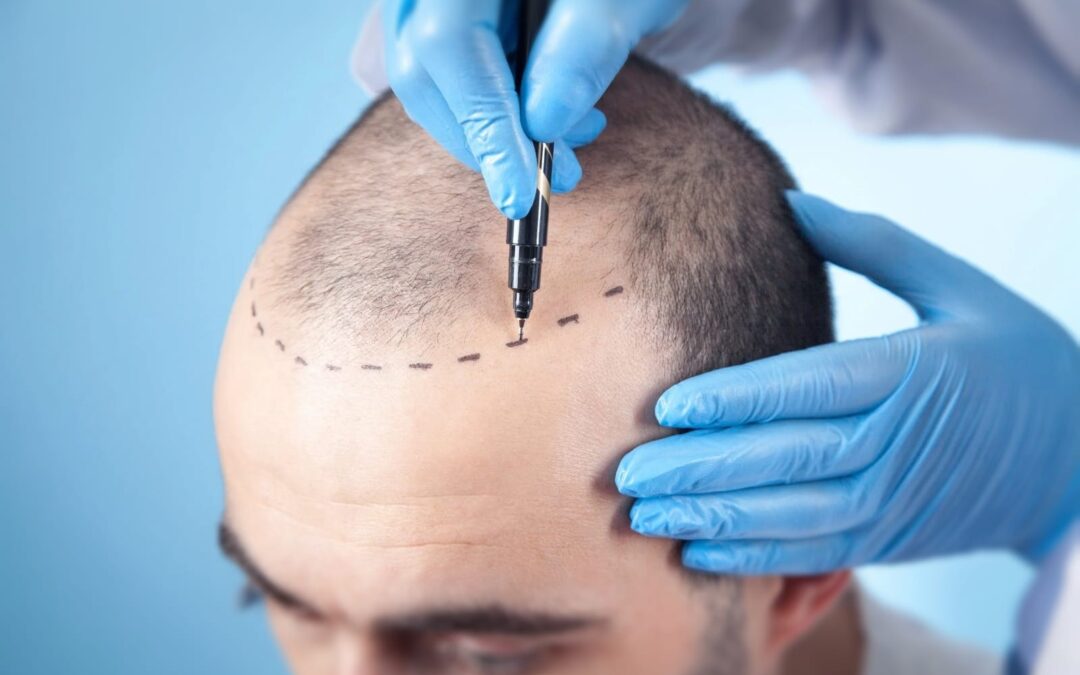 Hair Transplant